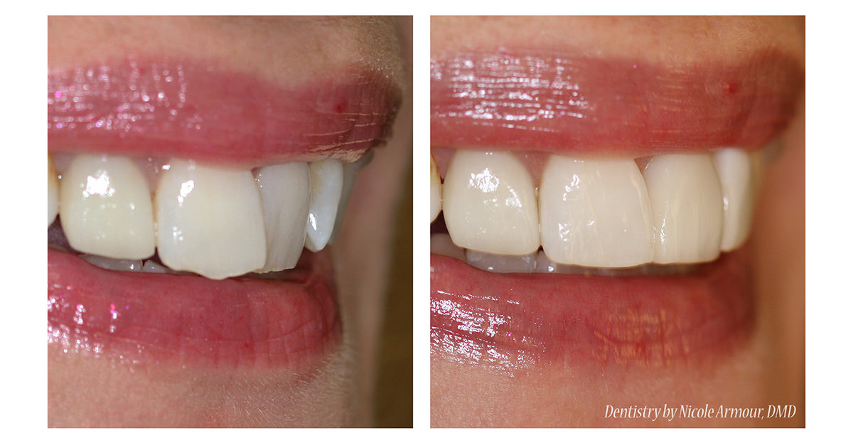 A Sneak Peak of our Newest Cosmetic Bonding System - Armour Dentistry of Newtown