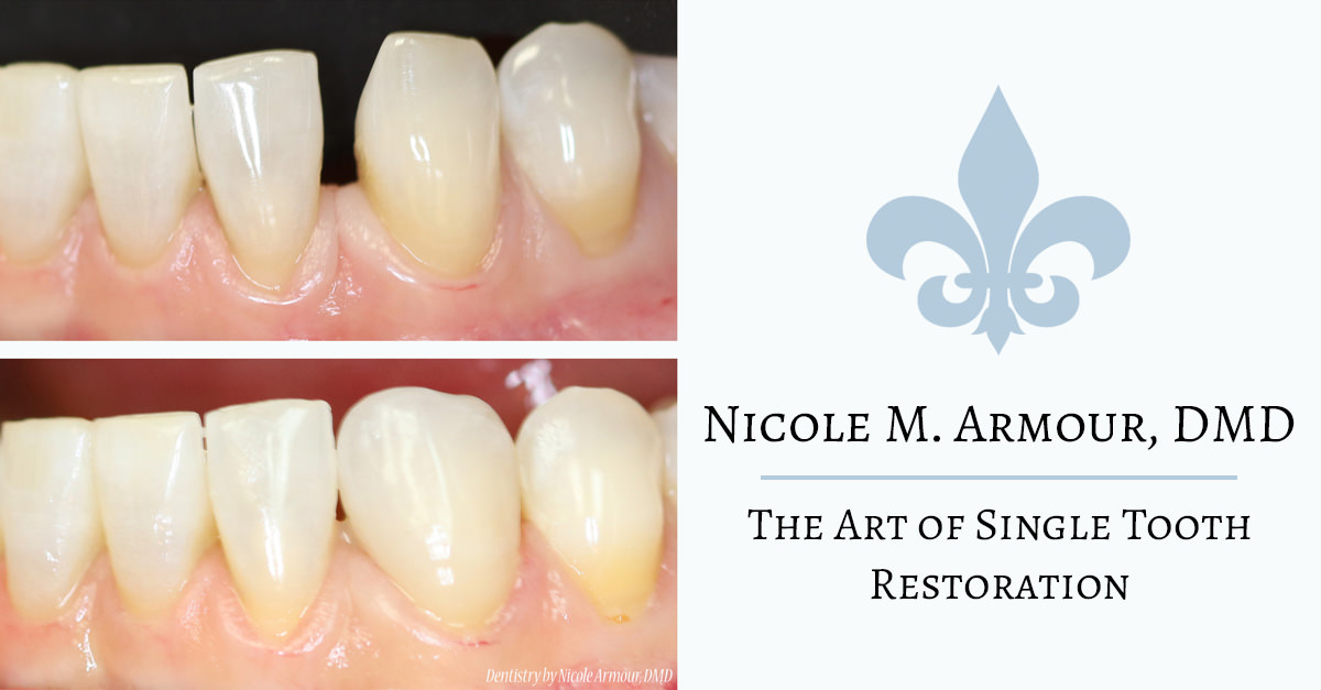 The Art of the Single Tooth Correction - Armour Dentistry of Newtown