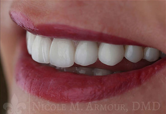 Beautiful natural looking end results - Nicole M Armour DMD