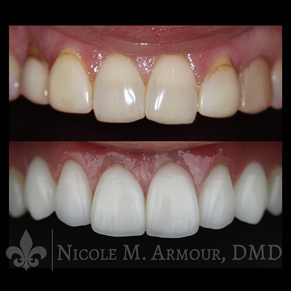 Natural looking veneers and implant crowns - Nicole M Armour DMD