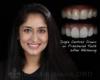Conservative smile makeovers - teeth shading