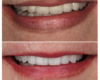 Veneers for Tetracycline stained teeth - Newtown Dentist Nicole M Armour, DMD