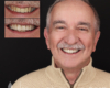 Cosmetic dental veneers by Dr. Armour in Newtown, PA