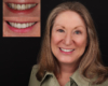 Whitening, Porcelain Crowns - Newtown PA Dentist Nicole Armour DMD